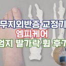 엄지 | 무지외반증 교정기 엠피케어 엄지 발가락 휨 후기