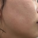 아쿠아플러스 남대구점 | 대구 피부숍 라플러스에스떼 후기 | 등 관리부터 아쿠아필 듀얼손까지 받은 솔직 후기