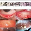 눈 이물감 심하다면 결막결석 의심 (눈결석, 오른쪽 왼쪽 눈통증) 이미지