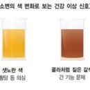 횡문근융해증 증상 및 원인과 치료 이미지