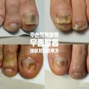 남동의료기 | 주손척척의원 무좀레이저치료후기 인천논현동 구월동 시흥 송도 남동공단 인천 정왕동 서래포구 무좀...