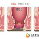 치핵의 증상 및 치료 방법 (항외과) 이미지