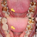 서울 오케이(OK) 치과의원 | 하남충치치료, 잘하는 곳 2가지 특징 (오버레이 사례)