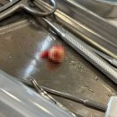 빼꼼낼름 | [일상] 미쳐버린 매복 사랑니 발치후기
