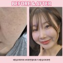 홈플러스 익스프레스 개봉점 | [왕십리피부과] 리쥬란힐러후기 2cc, 피부재생 효과에 따른 깐달걀 피부 만들기