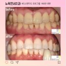 강남역 원데이 치아미백 3회 후기, 횟수, 이시림 증상