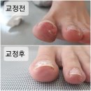 기장일광내성발톱교정,문제성발톱관리