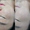 에이치앤에이치 | 에어플라즈마 관리 1회 받은 비포애프터 솔직 후기 📍광주신부관리 에이치앤에이치더바디