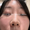 오가멍 | 신논현역피부과 리투오 후기, 멍 붓기 걱정돼서 캐뉼라 한 이유