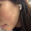 V-1 | 압구정윤곽주사, 유유V핏으로 얼굴 라인 정리 1회차 후기!