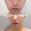 한번에 끝내는 역사 | 강남역 피부과 여드름흉터, 한 번에 끝내는 올인원레이저 후기