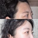 채움 | 신논현 성형외과 이마 필러 추천 더채움 내돈내산 후기