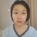 이종화외과의원 | ✅강릉 이종화외과 편평사마귀 제거 후기! 통증, 회복과정 솔직 리뷰