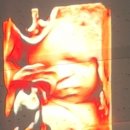 GS25 개금백병원점 | 개금백병원 고위험산모 쌍둥이진료 김영남교수님 32주차