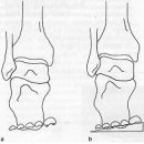 제 1 장 발보조기의 개요- 2. 발 보조기(foot orthosis)의 분류- 2.4 발보조기의 부품과 부속품 이미지