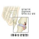 [하워드힐재활요양병원] 통풍 (Gout) 이미지