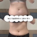 26290-20-07-171 | 부산 지방분해주사 1회차 급찐급빠 다이어트 뱃살 빼는 법 후기