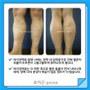 하지정맥류수술비 부담을 줄이는 Tip !! 이미지