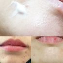 에이블덴탈 | 입주변 뾰루지 연고 티트리오일, 크림으로 극복함