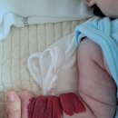 모나라피부과의원 | 마포 에스엔유피부과｜24개월 아기 혈관종 레이저 경험담