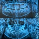 곧은치과의원 | 사랑니가 있었는데요 없어졌습니다