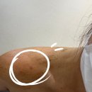 대전 둔산동 등드름 한의원치료 내돈내산 찐후기 2탄