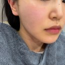 한올한올 | [강남역피부과] : 올타이트리프팅 한달 차 효과 내돈내산 후기