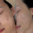 메이네A | [마포역] 피부관리 리앤메이뷰티스튜디오 커스터마이징 여드름 관리 솔직 후기