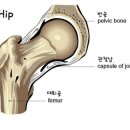 (고관절)고관절 질환 치료,고관절인공관절 수술법에대해 알아봅시다. 이미지