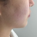 이마트24 대구메리어트호텔점 | 대구 동성로 피부관리 가꾸다 에스테틱에서 받은 더마리프핏 리프팅 후기