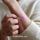 위례마음의원 | 위례마음 치료 이야기- 원인 모를 가려움, 피부 문제 아니라면?