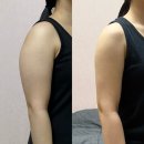 나는자연닭이다 인천마전점 | 람스 솔직 후기 인천 팔뚝지방주사 12주 팔뚝 -6cm, 체중 -7kg