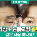 역대급 졸린눈에서 크고 또렷한 눈으로?! 이마거상+눈매교정 1년3개월차 경과 인터뷰! 이미지