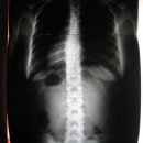 척추측만증 (Scoliosis)과 허리디스크 성공사례...SNPE 바른자세,척추교정운동수련 이미지