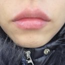 성포마루한방병원 | 수지구청역피부과 입술필러 인생처음후기