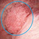 Case_Study_749:왼쪽 사타구니 통증이 점점 심해지는 64세 남자_요로상피암(Urothelial carcinoma)