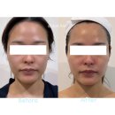 대구 수성구 피부관리 정인에스테틱 : 3V윤곽관리 &amp; 물방울 리프팅 기기관리 솔직후기