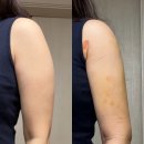 옷빨 | 팔지흡 후기, 일주일 붓기 멍 통증 어떨까? (리얼 변화 기록 써머리)