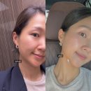 홍아 | 강남역 피부과 덴서티하이 600샷 l 고주파리프팅 솔직후기_홍아나