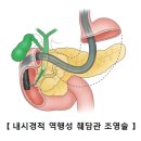 간문부 담관암 (Klatskin's tumor) 이미지