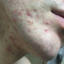 비타민한의원 | 여드름전문한의원 다니며 흉터 제거한 후기