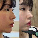 강남통증의학과 | 강남이비인후과 무보형물 코끝 수술 1주차 전후 변화 통증 관리 후기