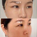 눈꼬리 실리프팅 후기 캣츠아이로 또렷한 눈매 변화 전후 공개