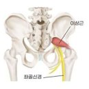 엉덩이 통증 원인 6가지 이미지