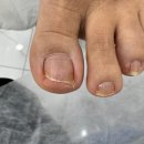 부평내향성발톱 편한하게 관리받은 썰 레푸스부평CGV점