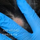 SMP 스튜디오 두피 엑소좀 | 스트레스 급성탈모 시술 솔직후기