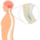 Re: 기립성 저혈압, 척수 공동증 .. 갑자기 혈압이 떨어지는 기전 neurogenic autonomic dysfunction 이미지