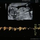 송산부인과의원 | [둘째 프로젝트] 임신 15주 6일, 오창 미즈산부인과의원, 정기 진료, 초음파 진료, 신경관 결손 검사...