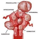 자궁근종(원인, 종류, 증상, 진단) 이미지