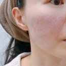 엘라비 | 문정동 피부과 제이윤피부과 리투오 스킨부스터(통증, 유지기간) 내돈내산 후기!